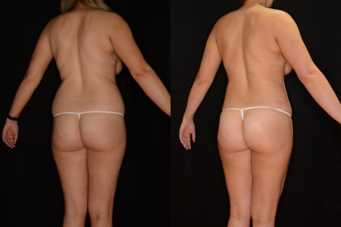 Before & After Liposuction Case 527 View #2 View in Panama City & Pensacola, Florida