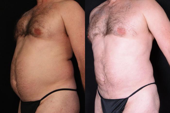 Before & After Liposuction Case 530 View #1 View in Panama City & Pensacola, Florida