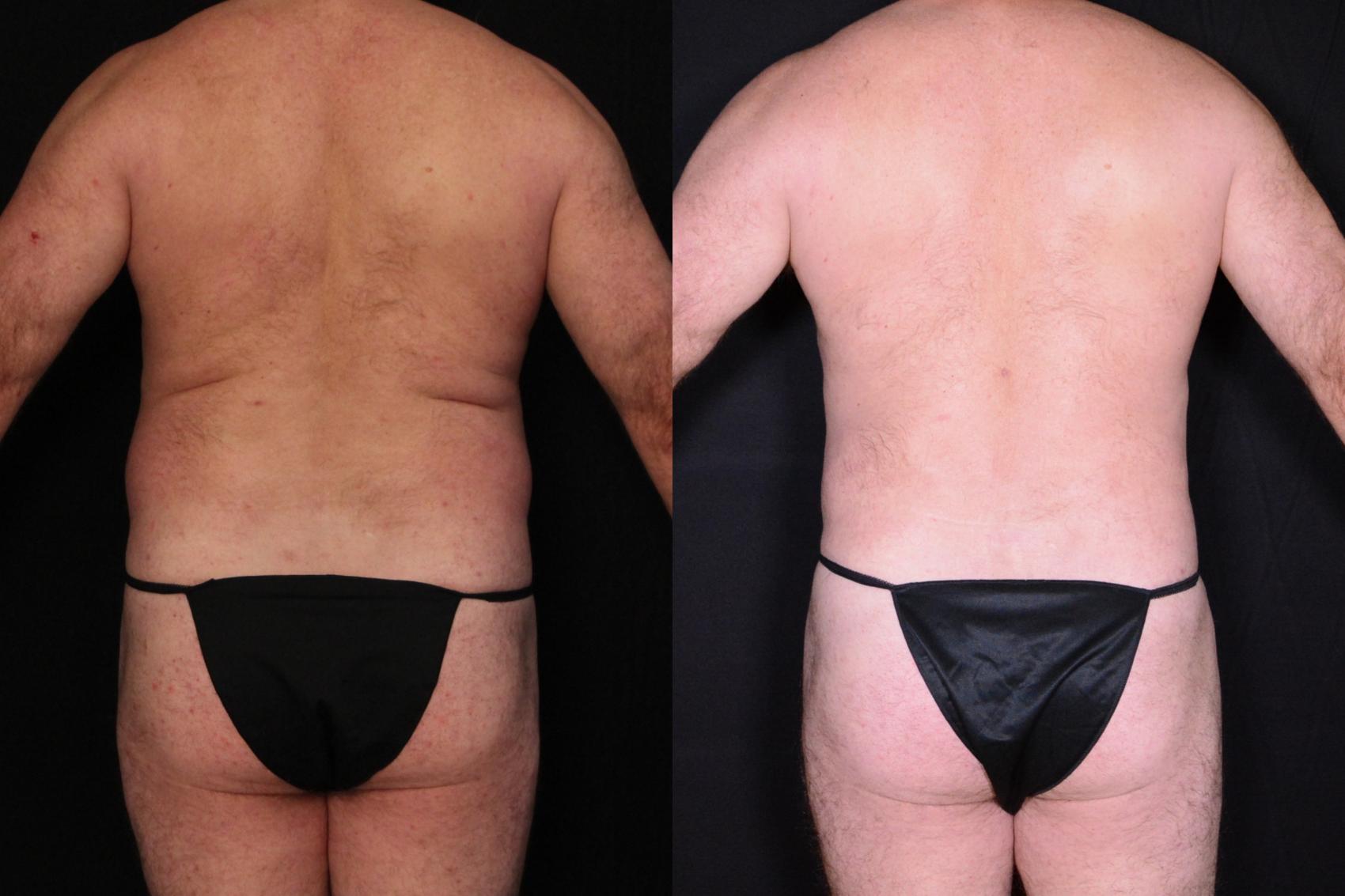 Before & After Liposuction Case 531 View #1 View in Panama City & Pensacola, Florida