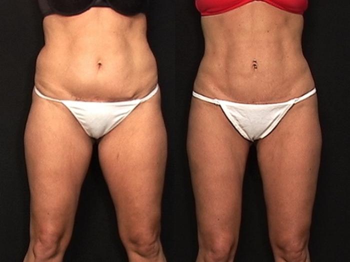 Before & After Liposuction Case 539 View #1 View in Panama City & Pensacola, Florida
