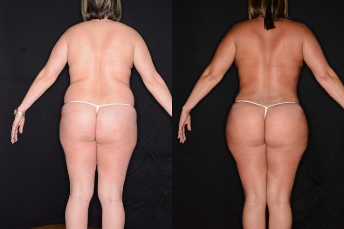 Before & After Liposuction Case 566 View #1 View in Panama City & Pensacola, Florida