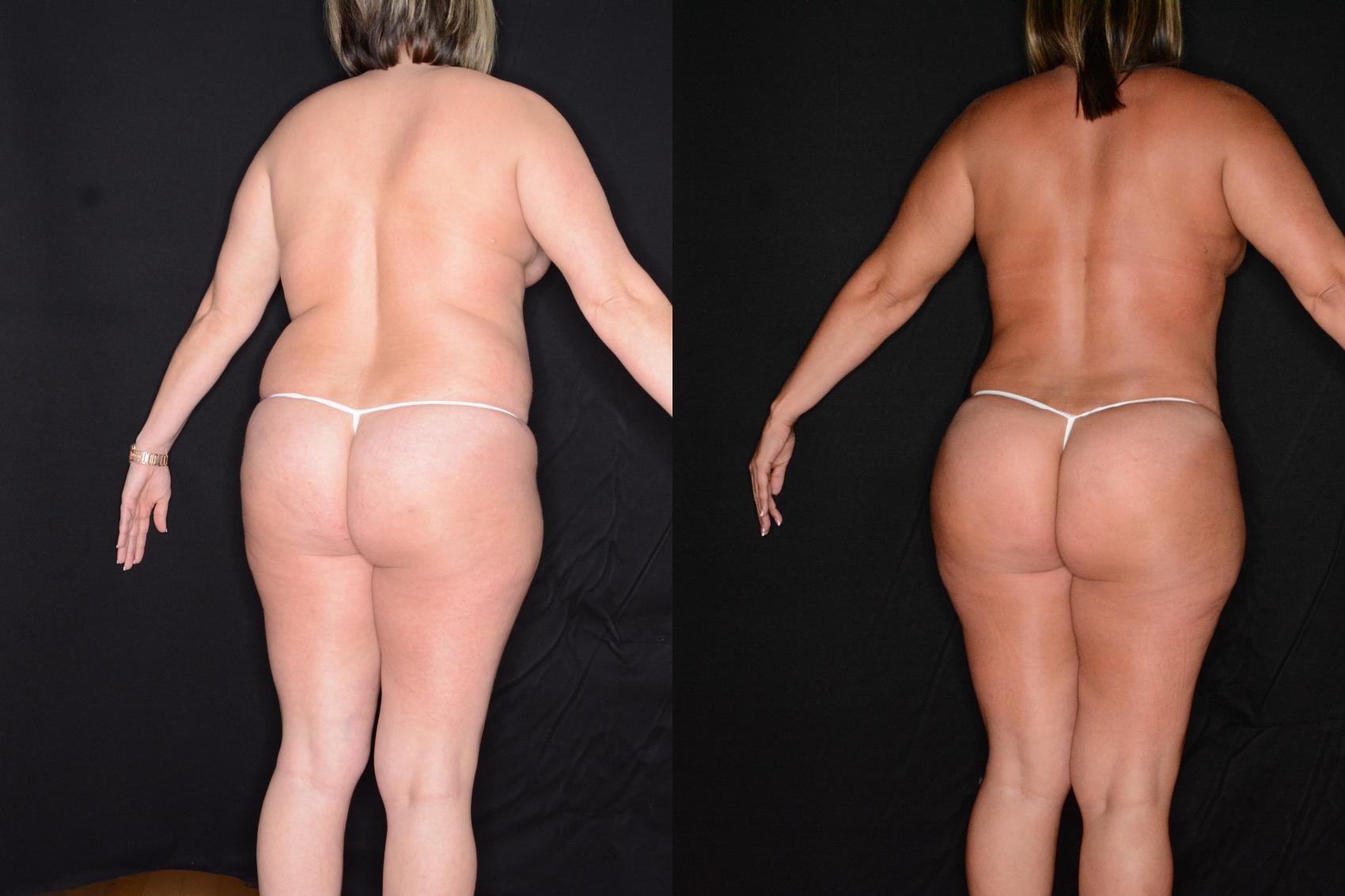 Before & After Liposuction Case 568 View #1 View in Panama City & Pensacola, Florida