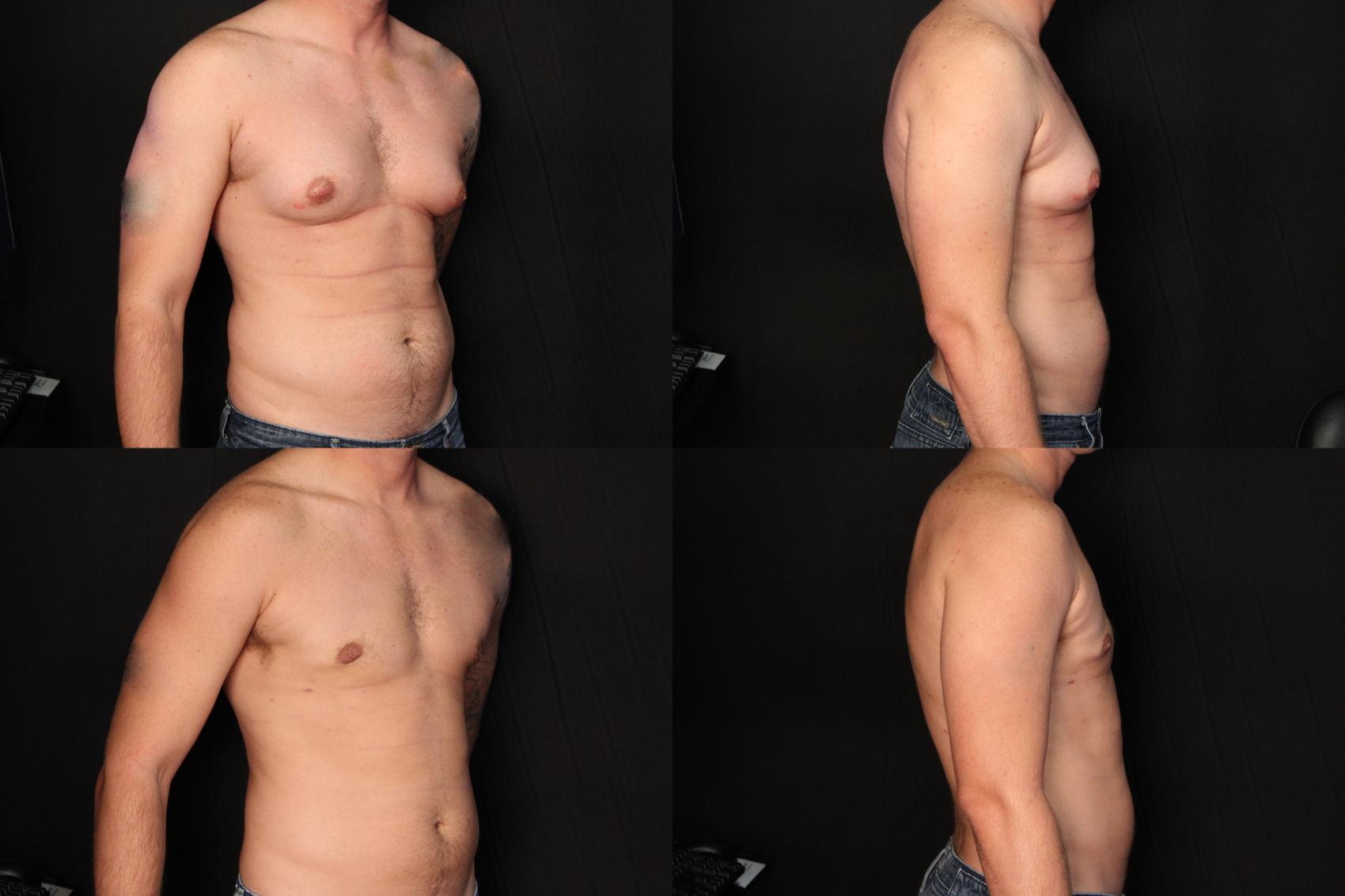Before & After Male Breast Reduction Case 445 View #1 View in Panama City & Pensacola, Florida