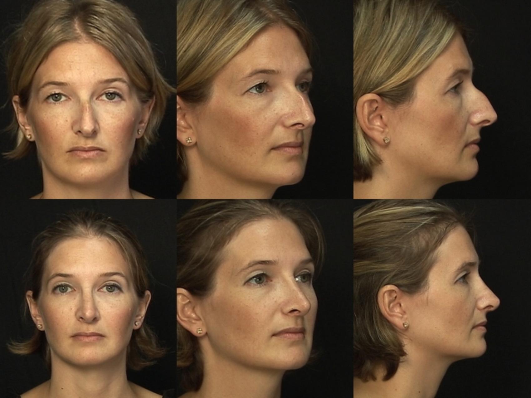 Before & After Rhinoplasty Case 230 View #1 View in Panama City & Pensacola, Florida