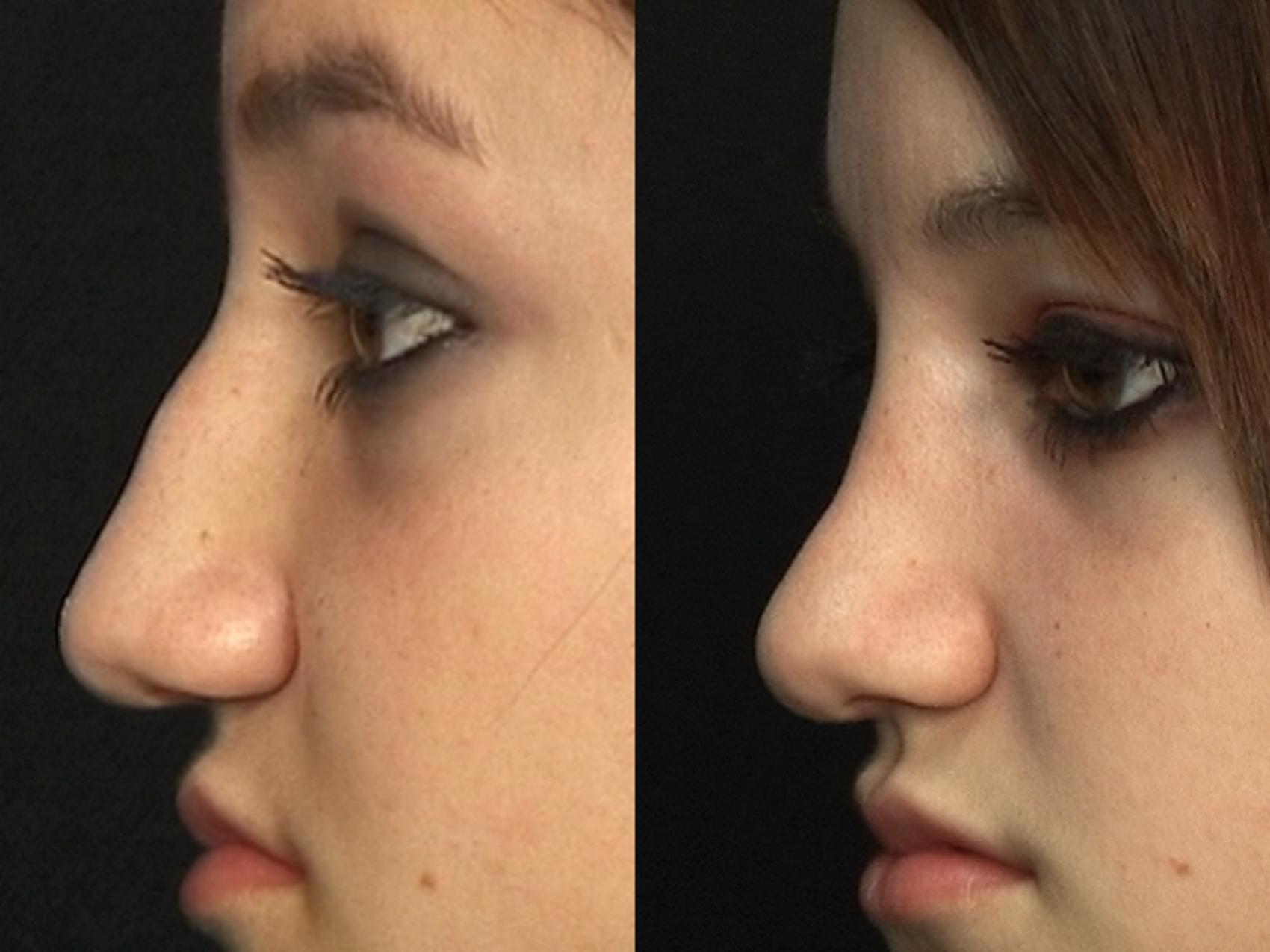 Before & After Rhinoplasty Case 3 View #2 View in Destin & Pensacola, Florida