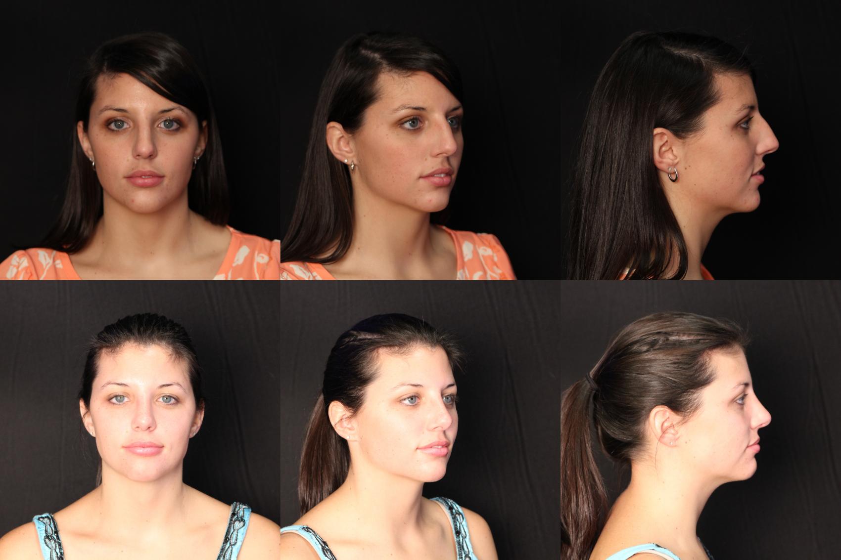 Before & After Rhinoplasty Case 403 View #1 View in Panama City & Pensacola, Florida
