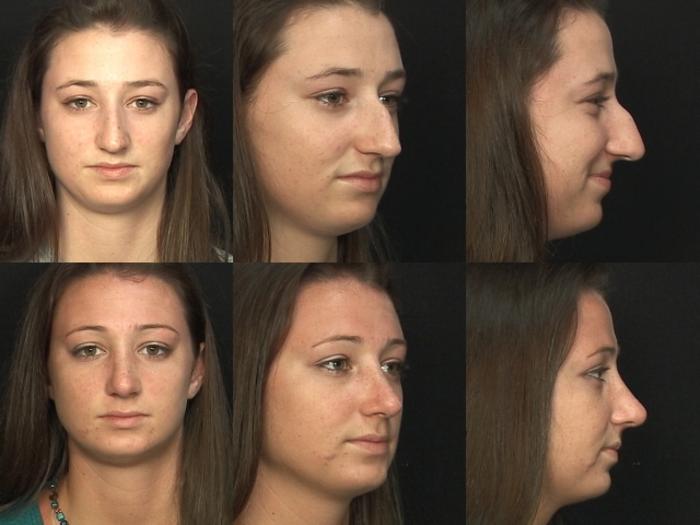 Before & After Rhinoplasty Case 5 View #1 View in Panama City & Pensacola, Florida