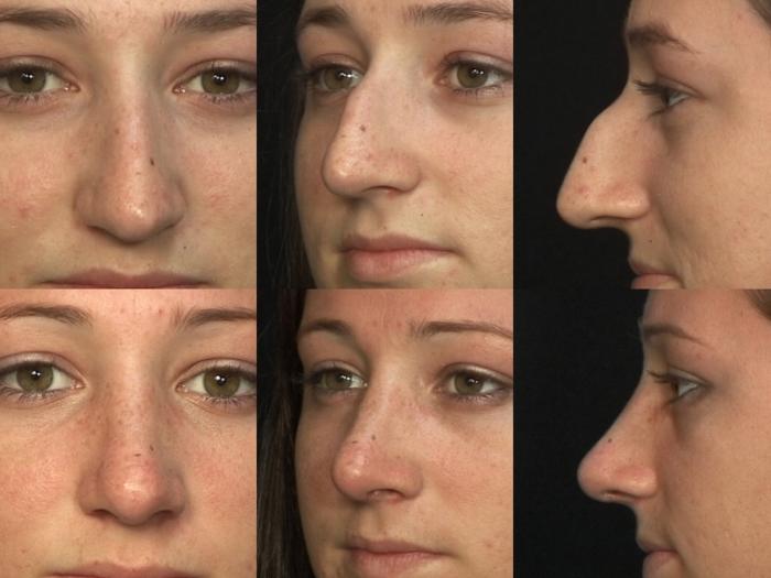 Before & After Rhinoplasty Case 5 View #2 View in Panama City & Pensacola, Florida