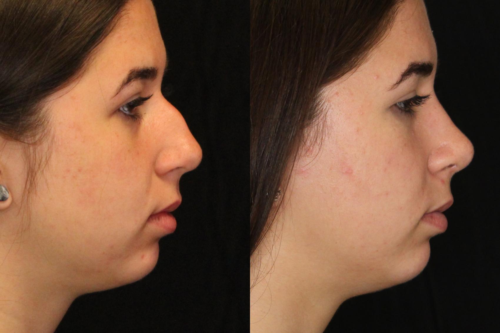 Before & After Rhinoplasty Case 569 View #1 View in Panama City & Pensacola, Florida