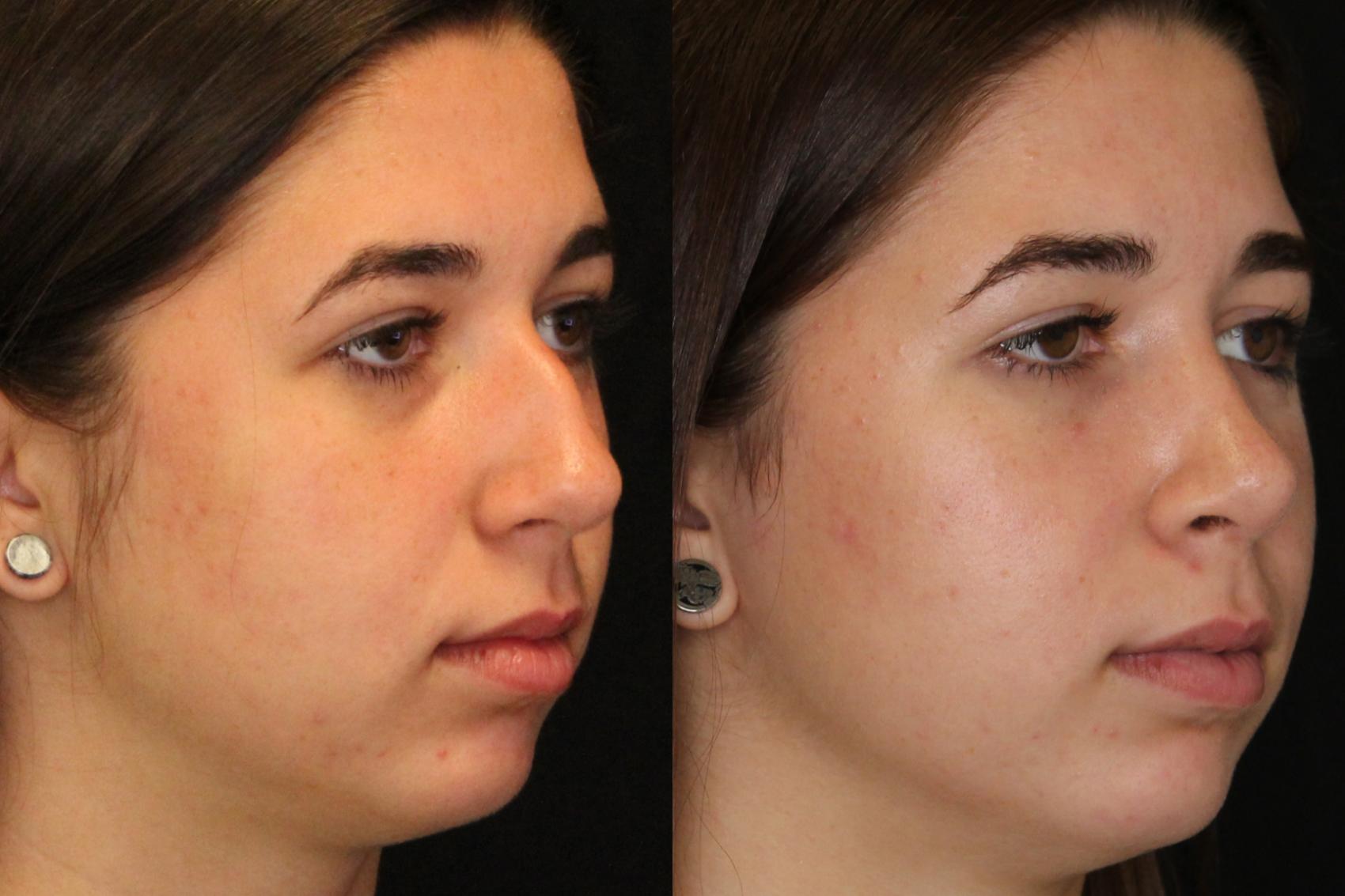 Before & After Rhinoplasty Case 570 View #1 View in Panama City & Pensacola, Florida