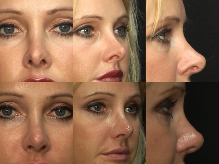 Before & After Rhinoplasty Case 6 View #1 View in Panama City & Pensacola, Florida