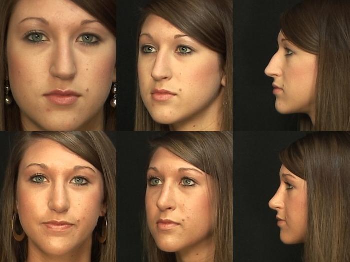Before & After Rhinoplasty Case 7 View #1 View in Panama City & Pensacola, Florida